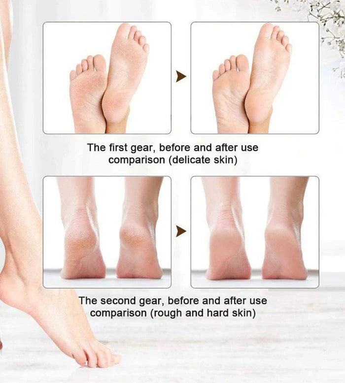 Electronic Foot Grinder – Rechargeable Pedicure Tool Buy Online