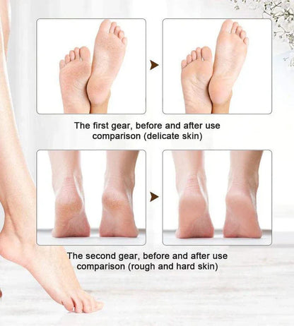 Electronic Foot Grinder – Rechargeable Pedicure Tool Buy Online